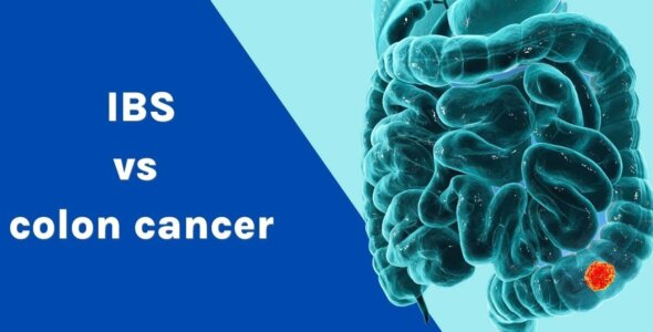 IBS vs colon cancer